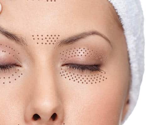 plasma eye lift manchester