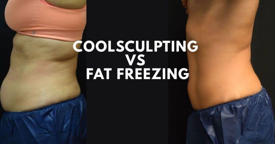 CoolSculpting vs Fat Freezing