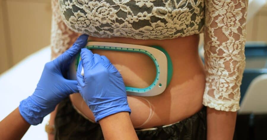 Science Behind Cryolipolysis Before And After Explained Simply